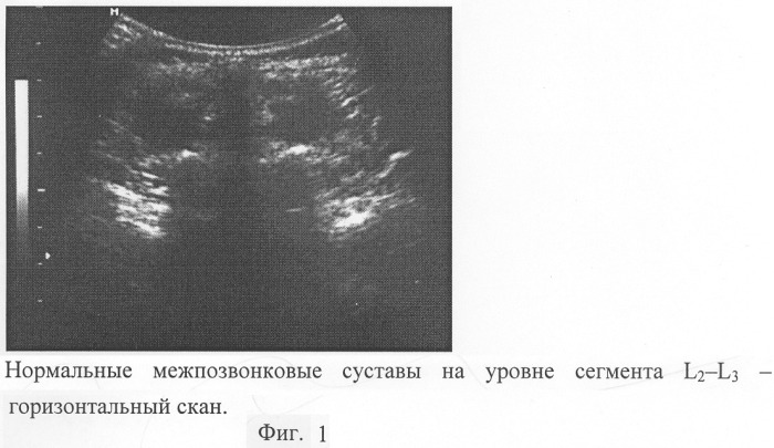 Способ диагностики патологии межпозвонковых суставов поясничного отдела позвоночника (патент 2299014)