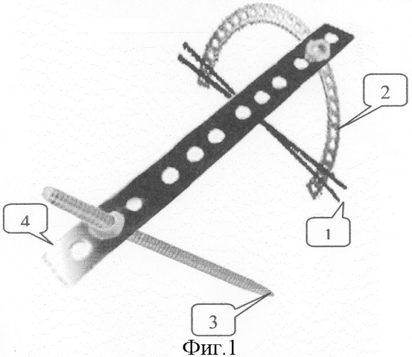 Способ фиксации верхней конечности к передней брюшной стенке при перемещении комплексов тканей на временной питающей ножке (патент 2306893)