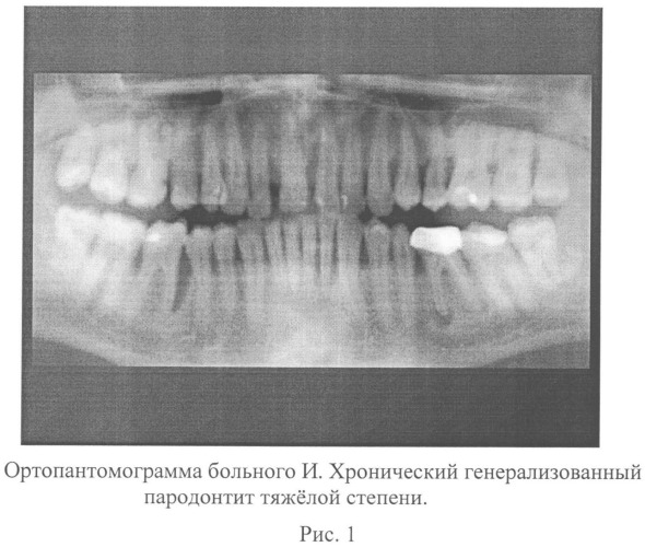 Способ оценки степени тяжести заболевания пародонта (патент 2546102)