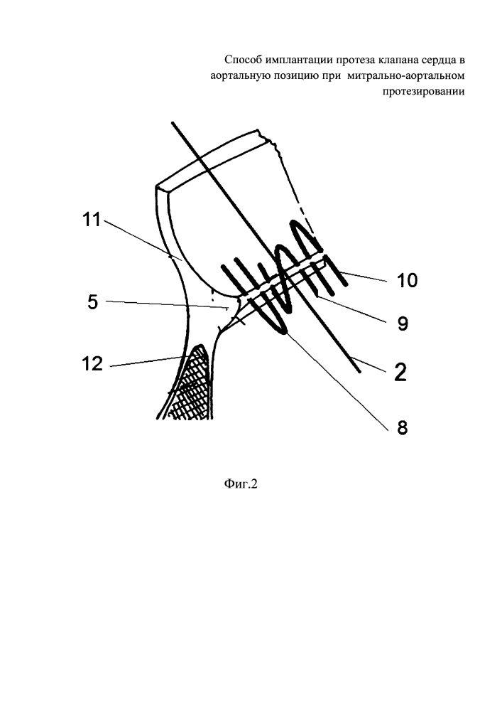 Способ имплантации протеза клапана сердца в аортальную позицию при митрально-аортальном протезировании (патент 2624313)