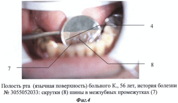 Способ шинирования зубов при пародонтите (патент 2436540)