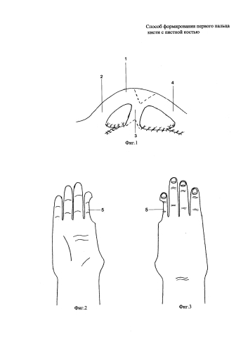 Способ формирования первого пальца кисти с пястной костью (патент 2577948)