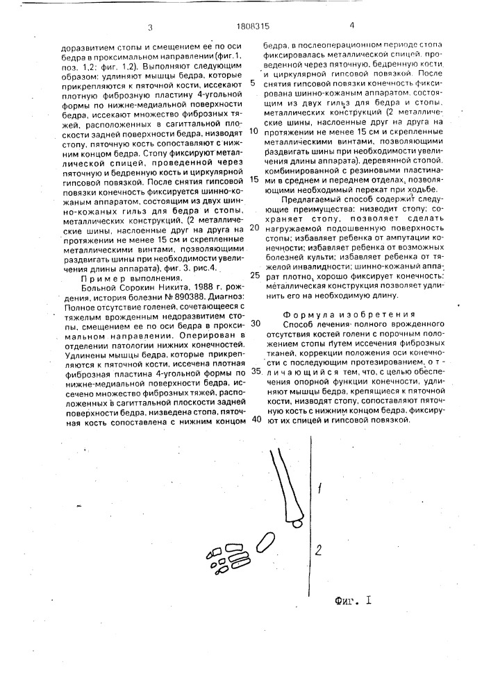 Способ лечения полного врожденного отсутствия голени с порочным положением стопы (патент 1808315)