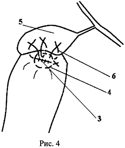Способ ушивания культи двенадцатиперстной кишки (патент 2522967)
