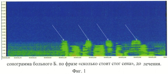 Способ определения восстановления фонетической функции после протезирования зубов (патент 2545418)
