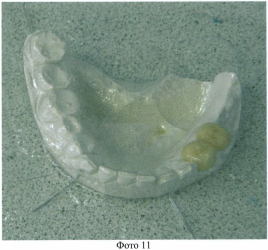 Способ изготовления временного зубного протеза (патент 2531445)
