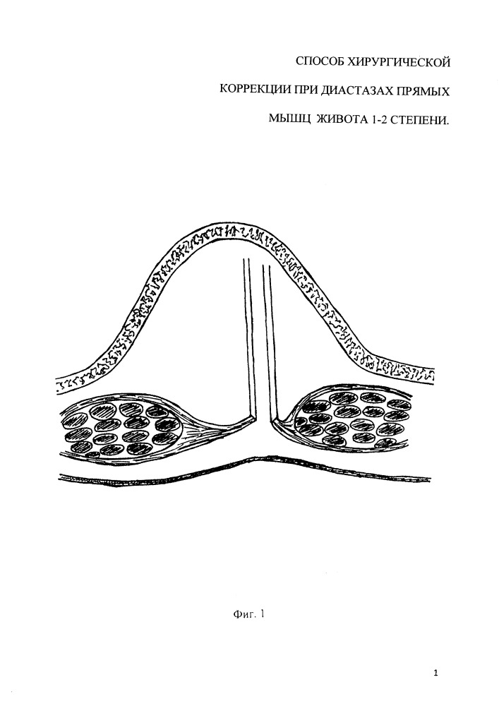 Способ хирургической коррекции при диастазах прямых мышц живота 1-2 степени (патент 2655519)