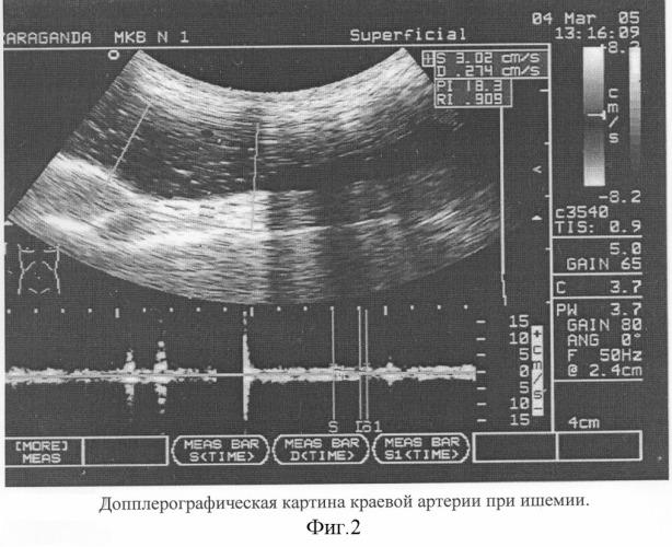 Способ оценки жизнеспособности ободочной кишки (патент 2295293)