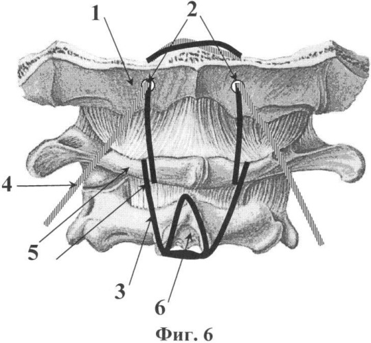 Способ фиксации шейно-затылочной области позвоночника (патент 2342915)