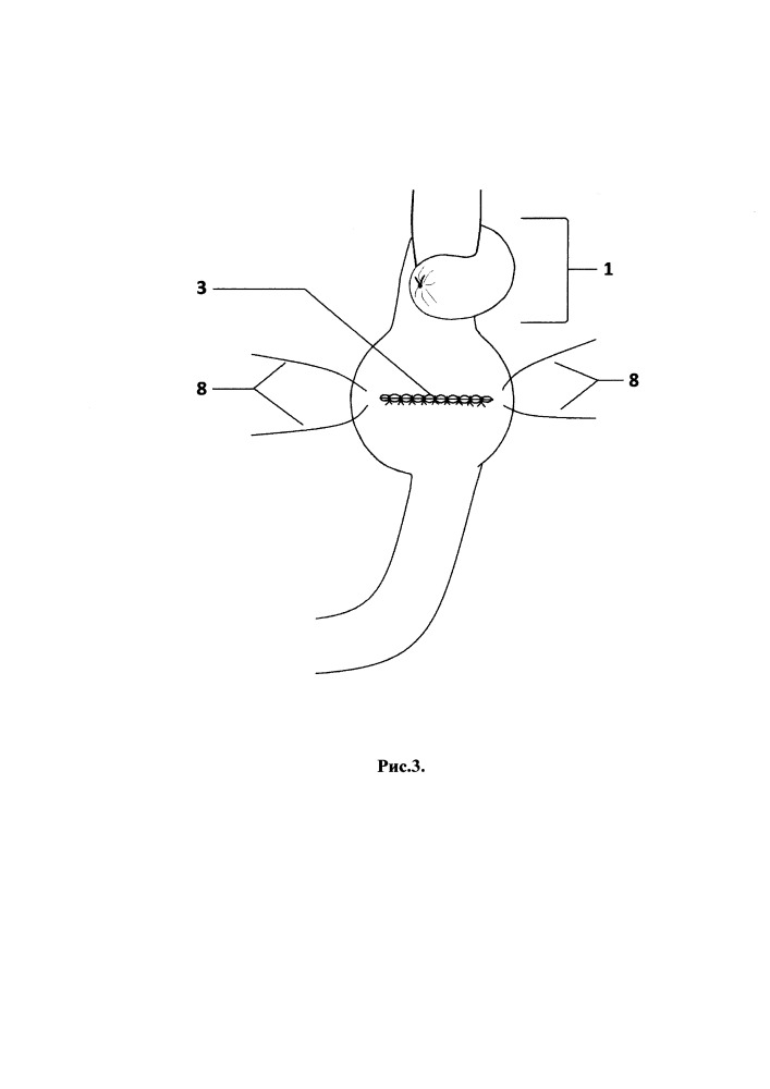 Способ восстановления непрерывности пищеварительного тракта после гастрэктомии (патент 2655980)