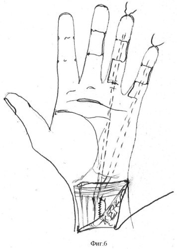 Способ несвободной аутогенной тендопластики глубоких сгибателей пальцев кисти путем транспозиции расщепленного сухожильного трансплантата (патент 2375980)