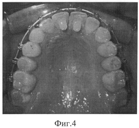 Способ ретенции результата ортодонтического лечения глубокого резцового перекрытия (патент 2495643)