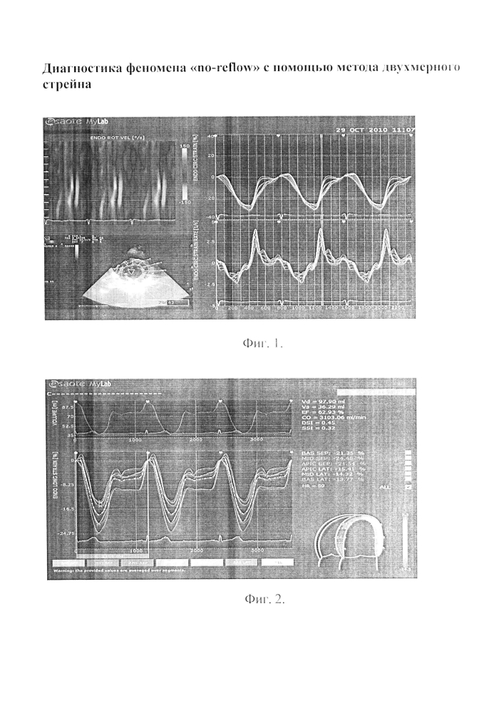 Диагностика феномена "no-reflow" с помощью метода двухмерного стрейна (патент 2602038)