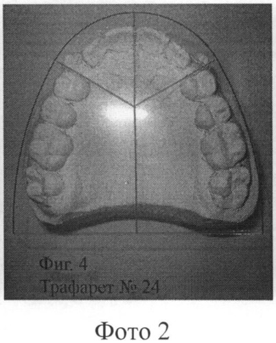 Способ контроля ортодонтической коррекции верхней зубной дуги и ее сегментов (патент 2486875)