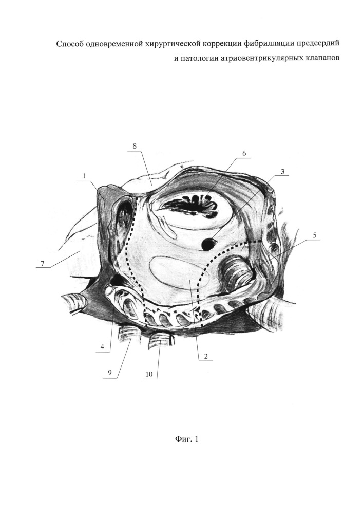 Способ одновременной хирургической коррекции фибрилляции предсердий и патологии атриовентрикулярных клапанов (патент 2644924)