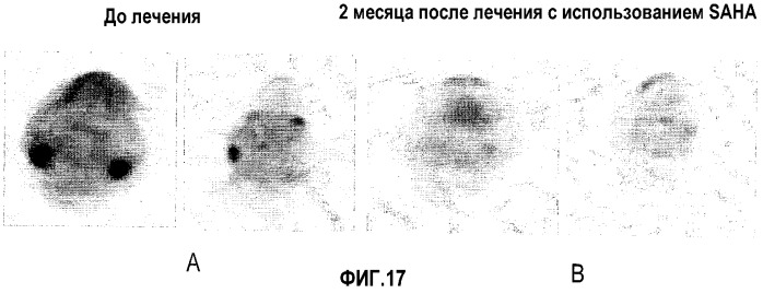 Способы лечения рака с использованием ингибиторов hdac (патент 2356547)