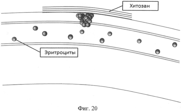 Раствор для получения материала на основе хитозана, способ получения гемостатического материала из этого раствора (варианты) и медицинское изделие с использованием волокон на основе хитозана (патент 2487701)