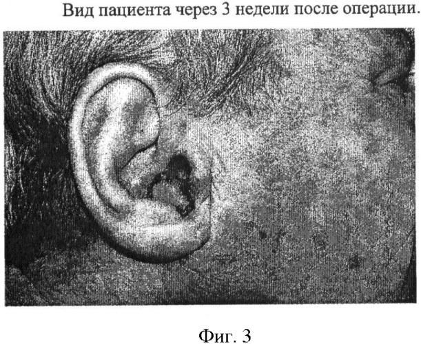 Способ пластики наружного слухового прохода (патент 2419404)