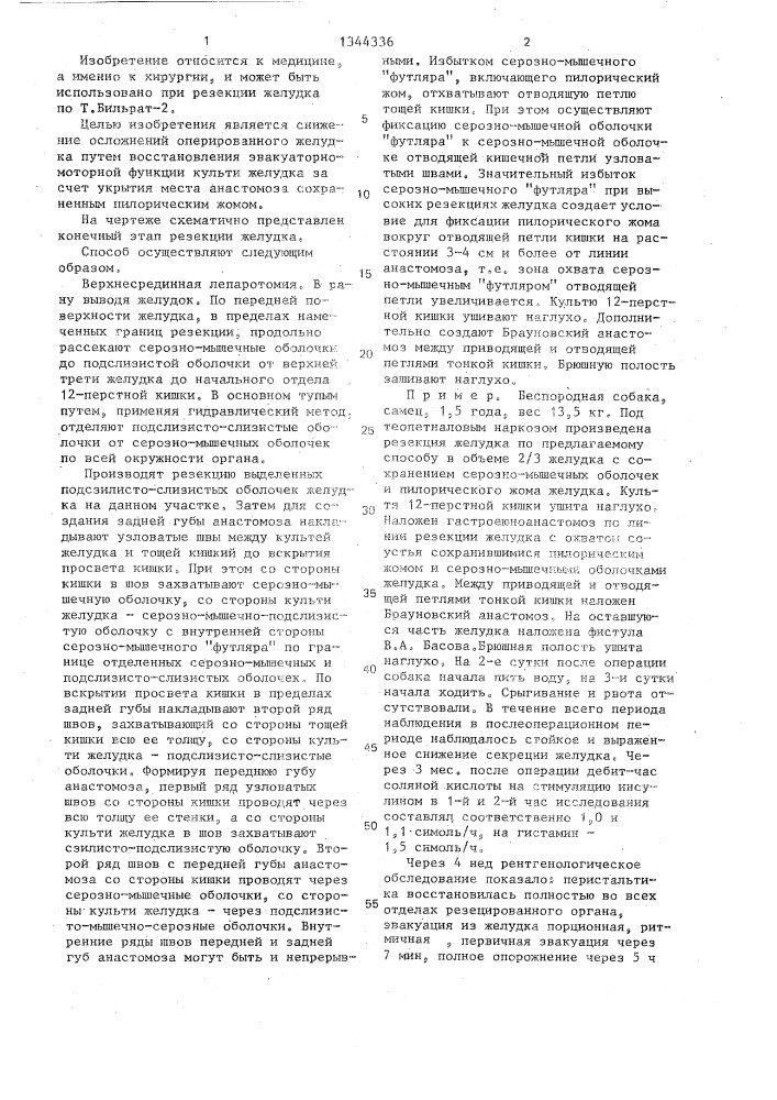 Способ резекции желудка (патент 1344336)