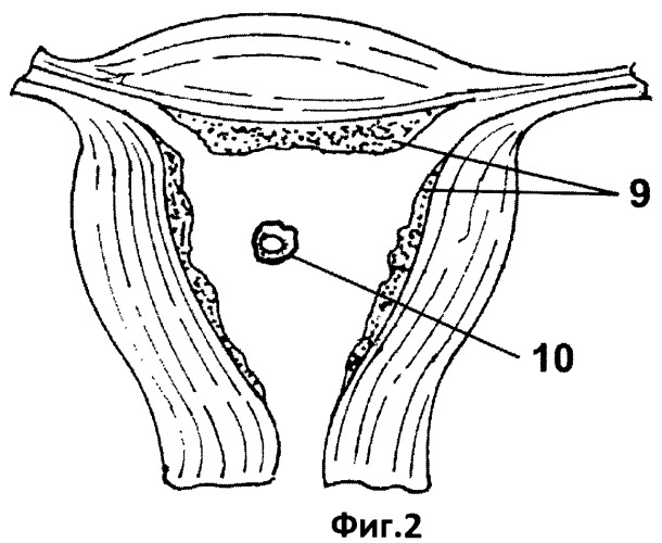 Размер полости матки. Имплантация эмбриона в эндометрий - Вигано.