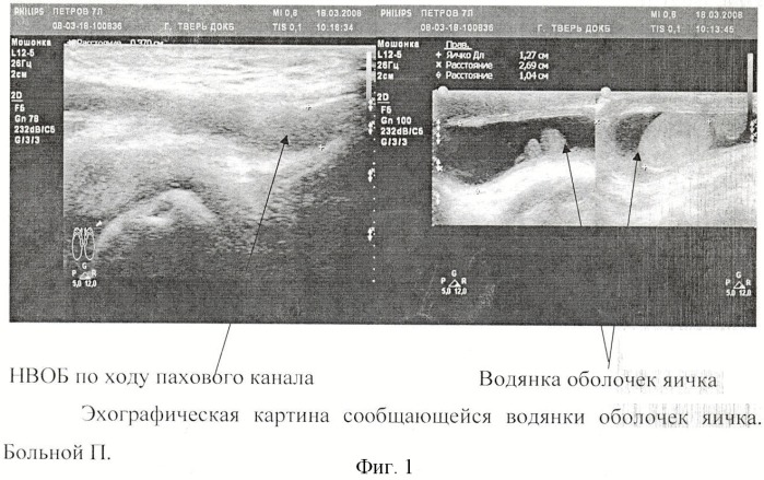 Способ определения показаний к выбору метода оперативного лечения водянки оболочек яичка у детей по данным комплексного ультразвукового исследования (патент 2438594)