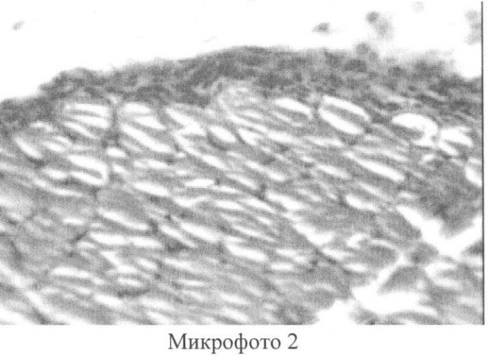 Способ профилактики образования спаек и их рецидива (патент 2331367)