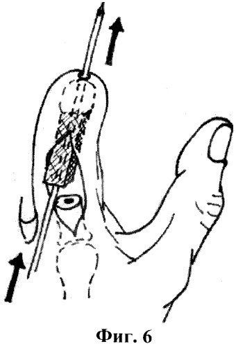 Способ двухэтапного удлинения культей трехфаланговых пальцев кисти (патент 2405469)