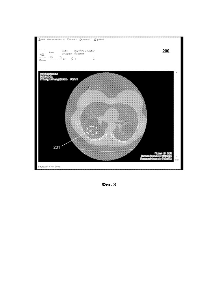 Способ и система сегментации изображений очагов легких (патент 2656761)