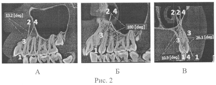 Способ измерения кривизны корневого канала зуба (патент 2550686)