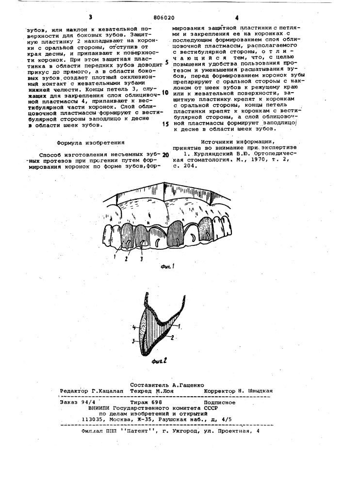 Способ изготовления несъемных зубныхпротезов при прогении (патент 806020)