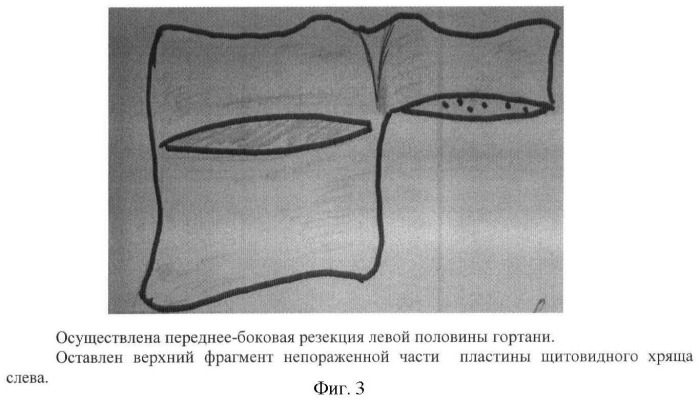 Способ реконструктивной операции на гортани (патент 2463967)