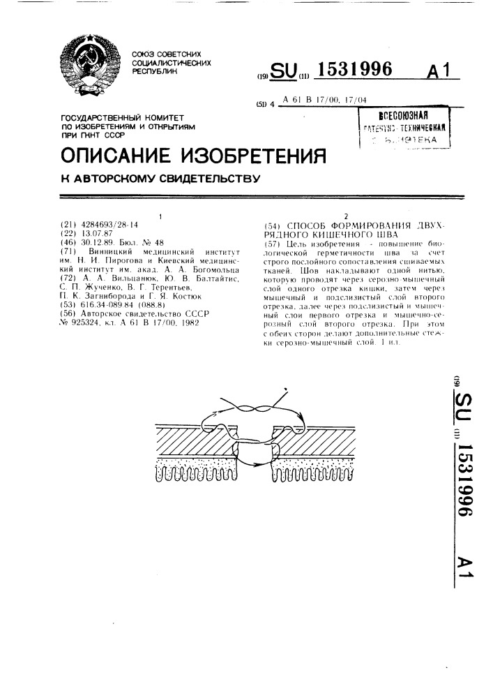 Способ формирования двухрядного кишечного шва (патент 1531996)