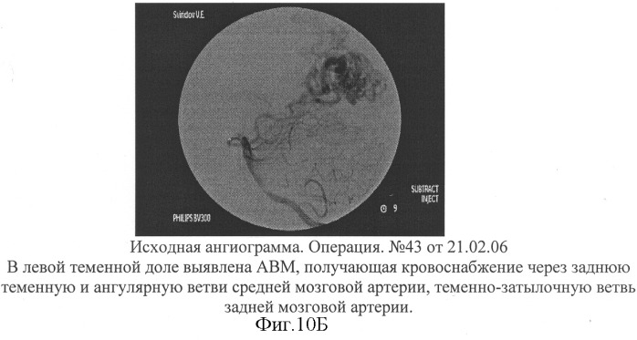 Способ эмболизации артериовенозных мальформаций головного мозга в условиях общей анестезии и управляемой гипотонии (патент 2315634)