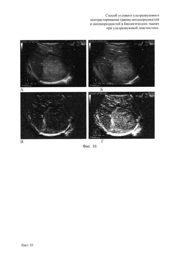 Способ углового ультразвукового контрастирования границ неоднородностей и неоднородностей в биологических тканях при ультразвуковой диагностике (патент 2648880)