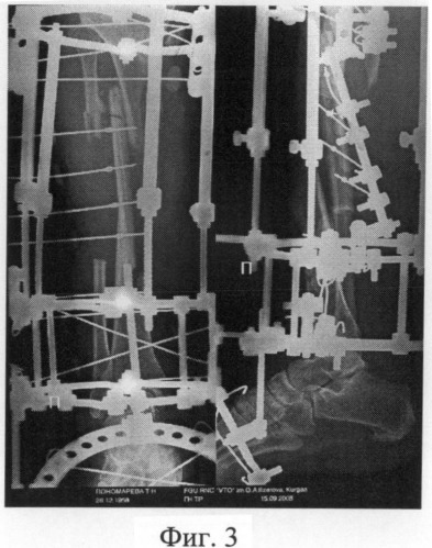 Способ замещения посттравматического дефекта большеберцовой кости, сопровождающегося обширной раневой поверхностью (патент 2487684)