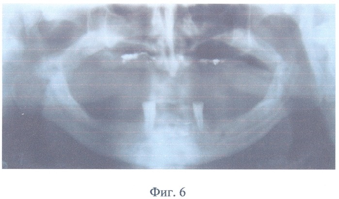 Полный съемный зубной протез верхней челюсти (патент 2314773)