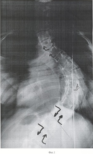 Способ коррекции грубых форм сколиоза (патент 2362503)