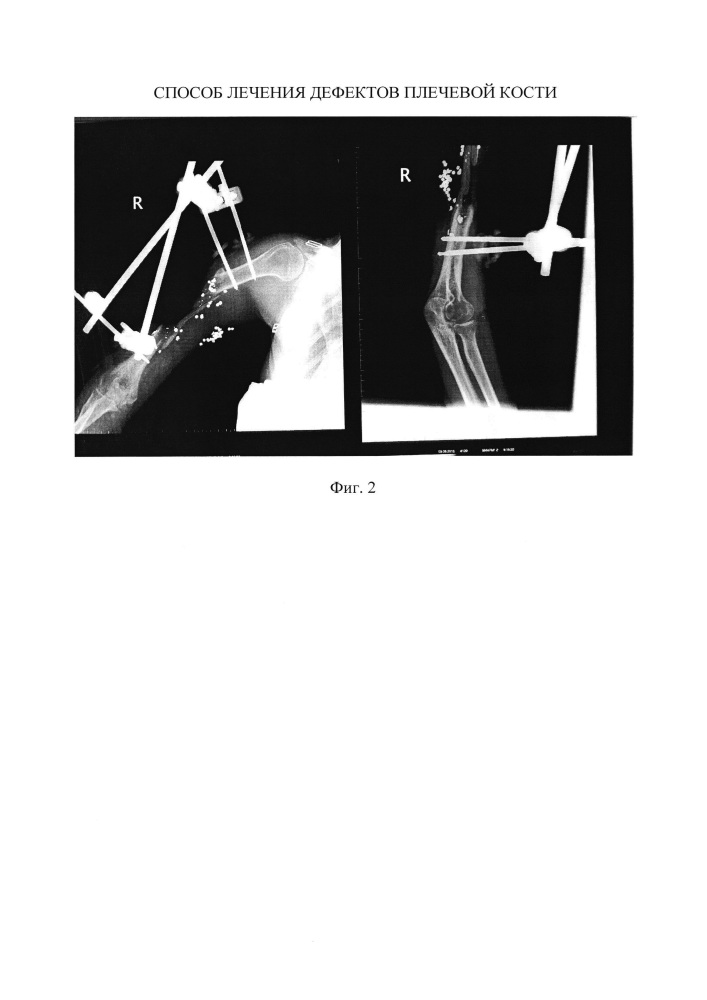 Способ лечения дефектов плечевой кости (патент 2617092)
