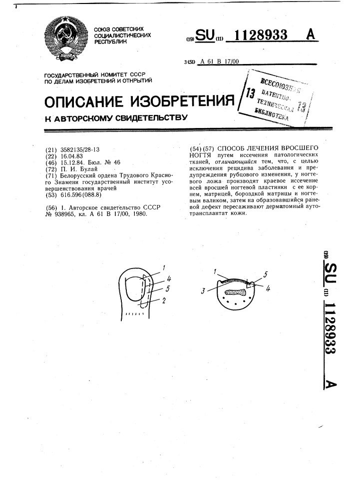 Способ лечения вросшего ногтя (патент 1128933)