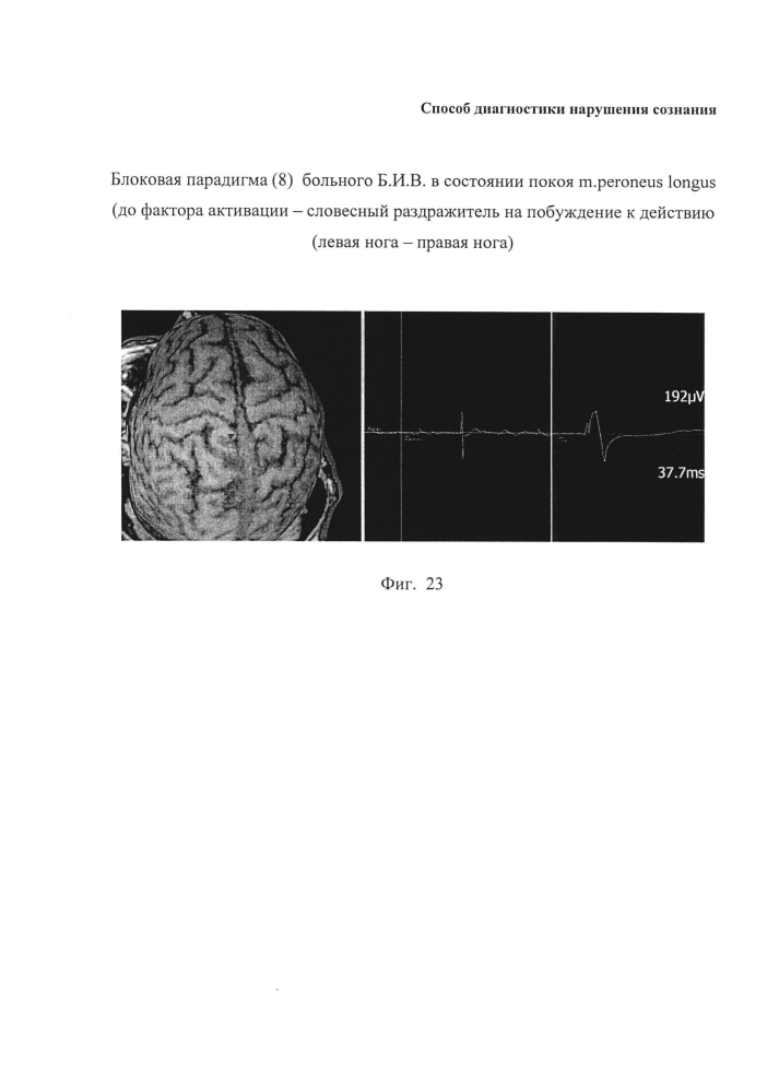 Способ диагностики нарушения сознания (патент 2596049)