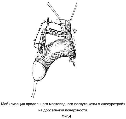 Способ формирования кожного лоскута при пластике уретры по поводу &quot;проксимальной&quot; гипоспадии по кравцову ю.а. - ii (патент 2467707)