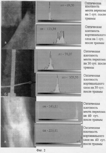 Программно-цифровой способ определения степени сращения переломов костей (патент 2255656)