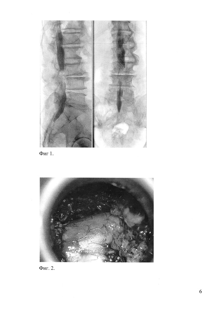 Способ лечения больных с поясничным спинальным стенозом (патент 2631637)