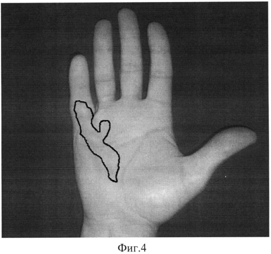 Способ идентификации границ поражения ладонного апоневроза при контрактуре дюпюитрена (патент 2553923)