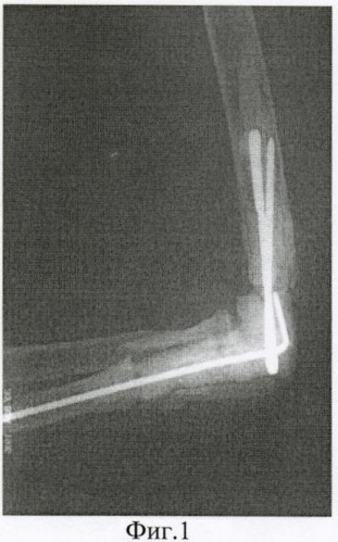 Способ сращения плечевой и локтевой костей в условиях обширных дефектов их сочленяющихся концов (патент 2406461)