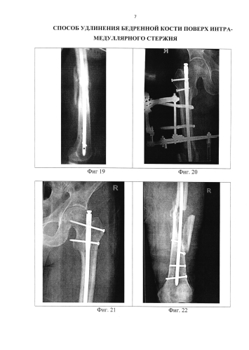 Способ удлинения бедренной кости поверх интрамедуллярного стержня (патент 2584555)