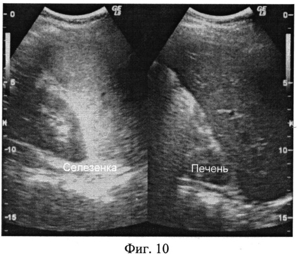 Способ ультразвуковой диагностики воспалительных изменений печени и селезенки при туберкулезе у детей (патент 2535613)