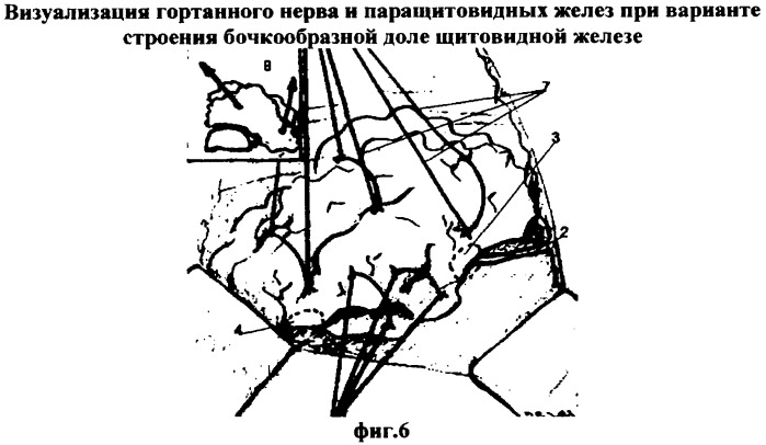 Способ экстрафасциального удаления доли щитовидной железы (патент 2357684)