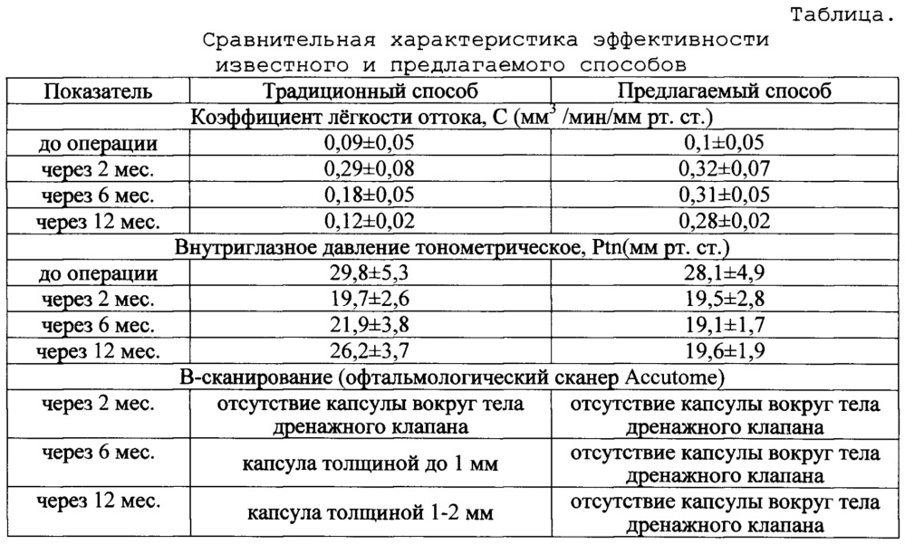 Способ установки дренажа при выполнении антиглаукомных операций (патент 2662147)