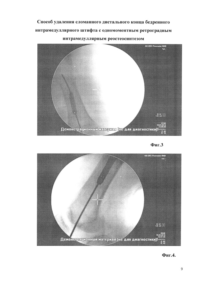 Способ удаления сломанного дистального конца бедренного блокируемого интрамедуллярного штифта с одномоментным ретроградным интрамедуллярным реостеосинтезом (патент 2653268)